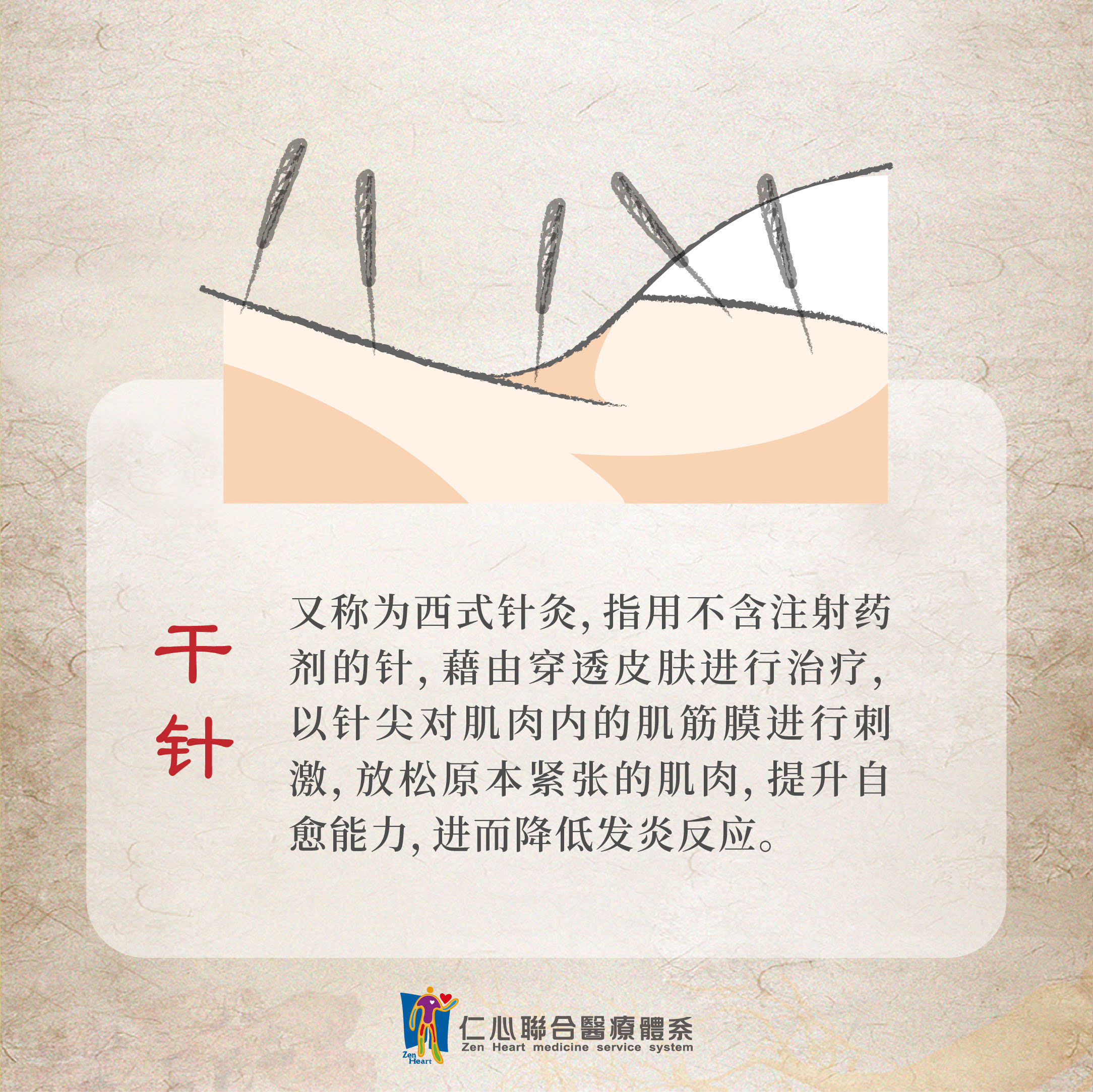 乾针